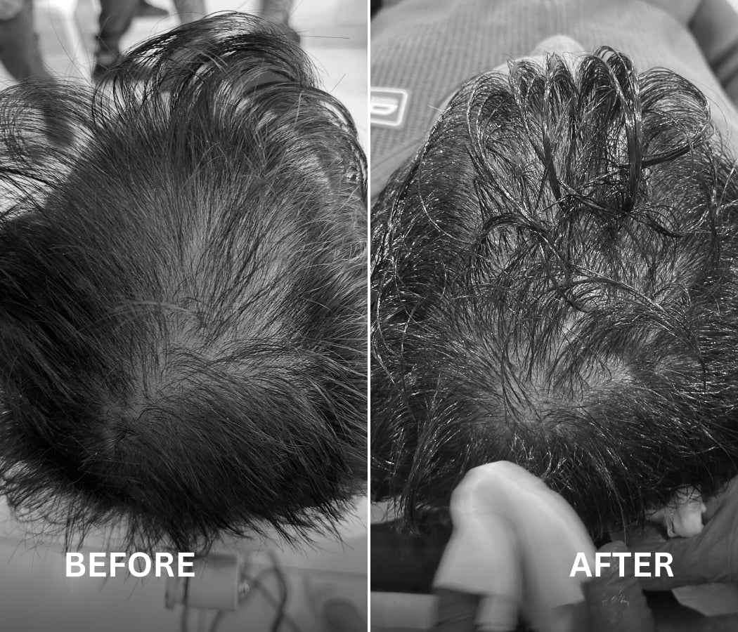 2 Octapep Hair Growth Serum + 1 NanoInfuser Dermastamp Combo