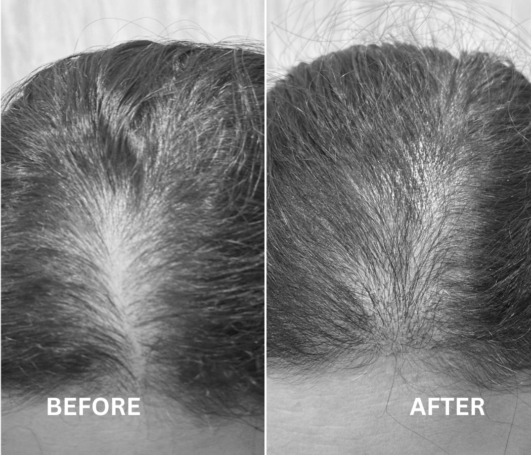 NanoInfuser - Microneedling Serum Applicator / Dermastamp – EnagenBio