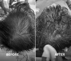 2 Octapep Hair Growth Serum + 1 NanoInfuser Dermastamp