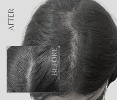 Degrease Pro - Anti Dandruff Scalp Serum