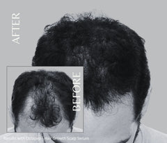 Octapep Hair Growth Serum + Degrease Pro Anti-Dandruff Scalp Serum Combo